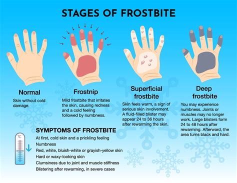 Frostbite symptoms: How cold does it need to be to get it and how fast does it occur? | The ...