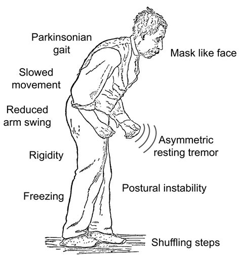 Parkinson Disease Treatment