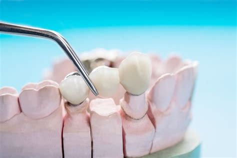 Conventional & Maryland Bridges Manningham Dental