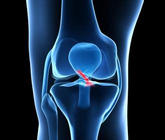 Torn ACL Surgery (Part 2): How? (Video) - Jeffrey H. Berg, M.D.