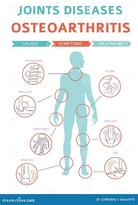 Joints Diseases. Arthritis, Osteoarthritis Symptoms, Treatment I Stock Vector - Illustration of ...