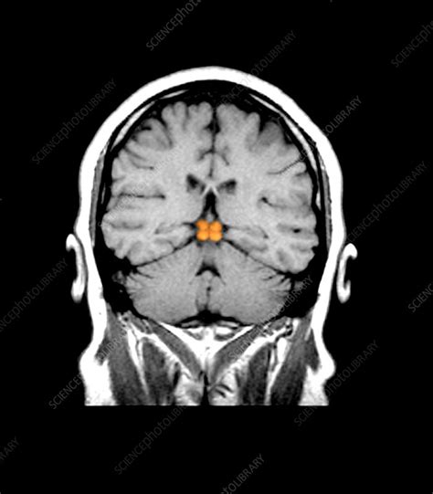 Inferior Colliculus Mri