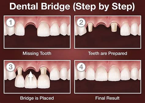 The Pros and Cons of a Dental Bridge | Dentist For Life