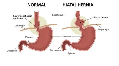 What's a Hiatal Hernia?: GastroDoxs PLLC: Gastroenterologists