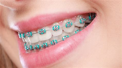 Metal braces – Im Orthodontics