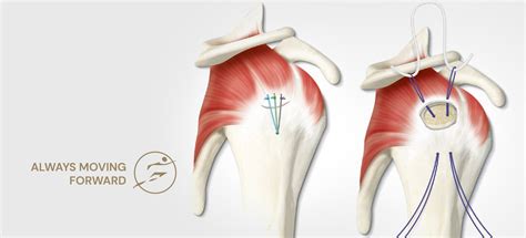 Arthroscopic Rotator Cuff Repair surgery, rotator cuff specialist in Indore