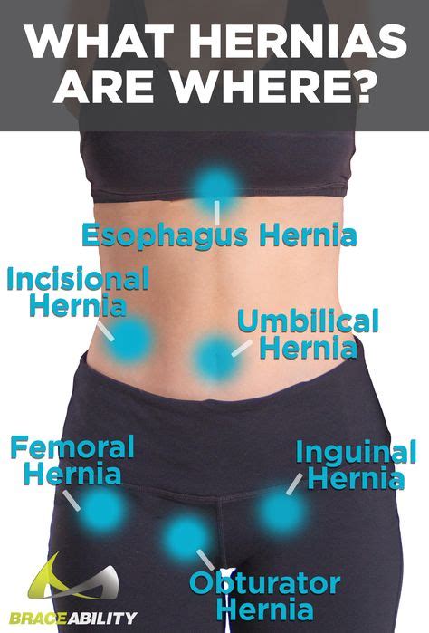 24 Hernia ideas | abdominal hernia, hernia inguinal, hernia exercises