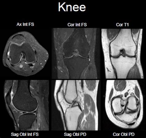 Knee MRI