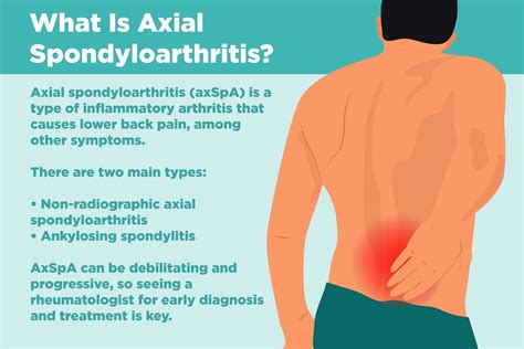 What is axial spondyloarthritis what to know about this inflammatory back pain – Artofit