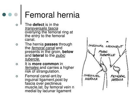 [DIAGRAM] Diagram Of Femoral Hernia - MYDIAGRAM.ONLINE