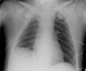 Pacemakers for Diaphragm Paralysis - Avery Biomedical