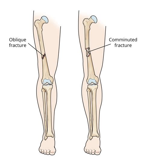 Closed Femur Fracture