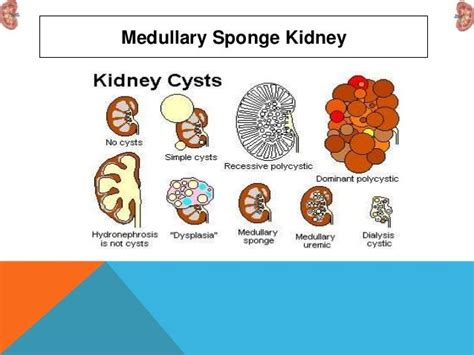 Medullary sponge kidney (msk)