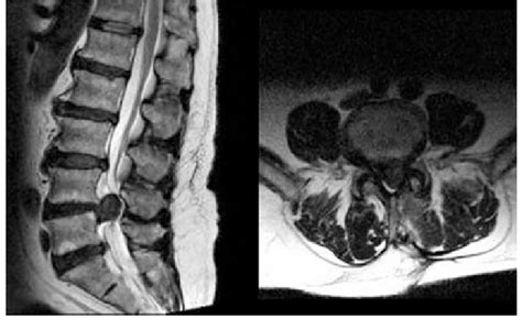 Lumbar Spine Mri Bulging Disc