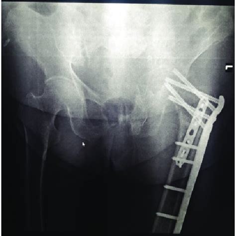 Plain radiograph showing that the proximal femoral nail antirotation... | Download Scientific ...