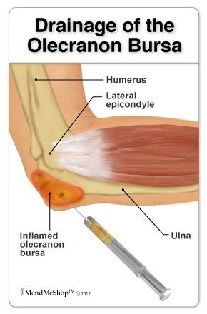 Bursa Surgeries