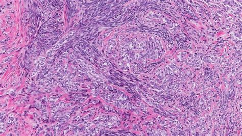 Synovial sarcoma - MyPathologyReport.ca