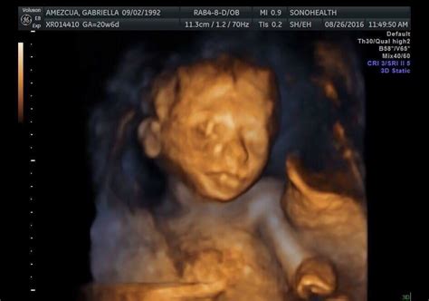 20 Week 3d Ultrasound - change comin