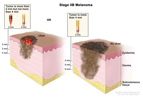 Melanoma Treatment - NCI