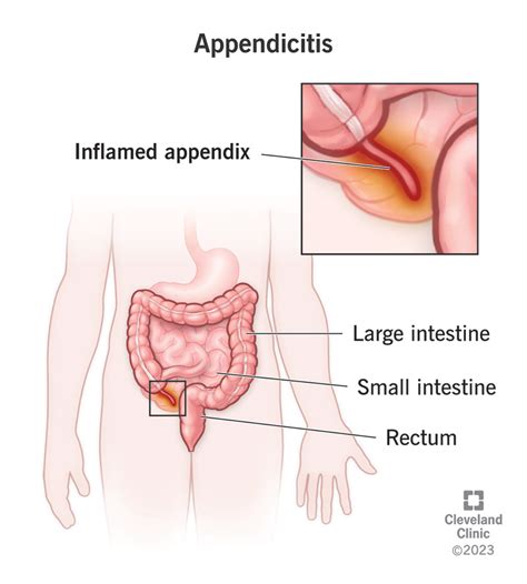 Understanding Appendicitis Symptoms and Treatment - Ask The Nurse Expert