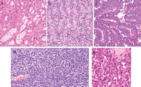 Unusual histology in primary pulmonary synovial sarcoma: Pearls to avoid misdiagnosis