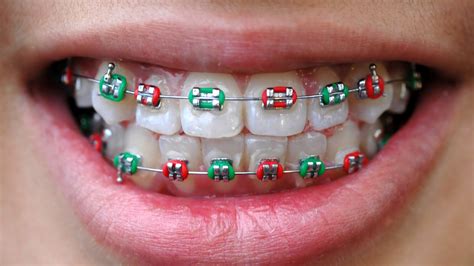 Beautiful Braces Colors | Dubai | Queens Medical Center