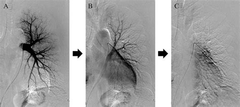 Figure5.Pulmonary angiography (PAG) images of the patient. The left... | Download Scientific Diagram