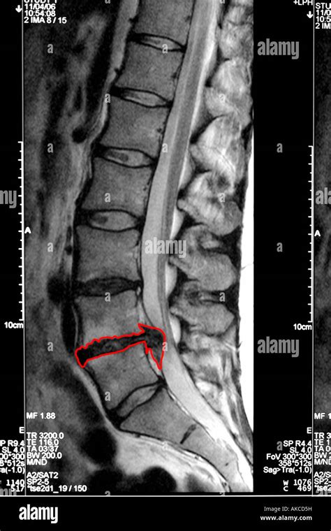 Mri Lumbar Spine Nerve