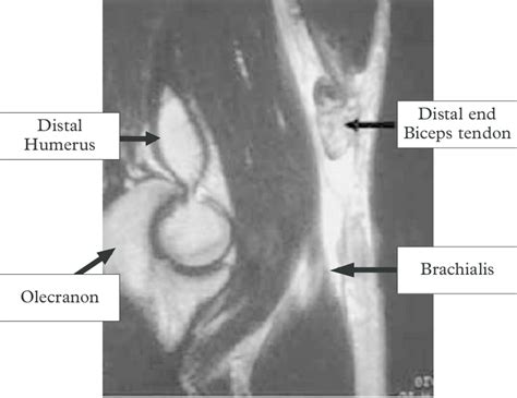 MRI ruptured biceps tendon. | Download Scientific Diagram