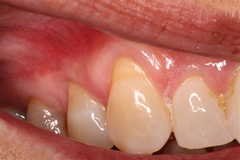 Receding Gums Causes, Prevalence, and Treatment - Ryan Lanman DDS, MSD