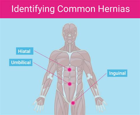 5 Signs You Have Hernia Mesh Complications | by MedTruth | Medium