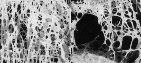 Metabolic bone disease | pathology | Britannica.com