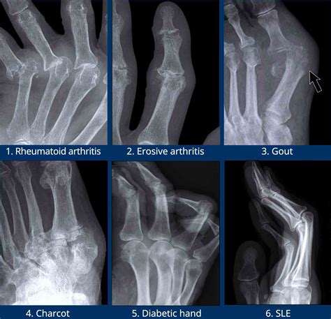 Rheumatoid Arthritis X Ray Knee