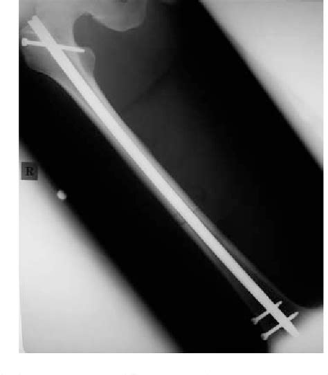 Femoral Fracture Caused by Removal of Femoral Intramedullary Nail Made of Stainless Steel ...