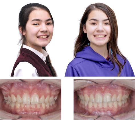 Before-and-After Braces & Invisalign | Matsumoto Orthodontics & Periodontics