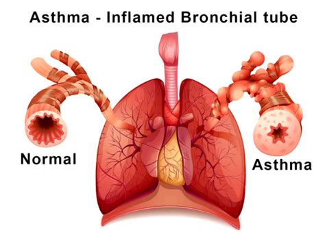 disorders of respiratory system in biology: Definition, Types and Importance | AESL