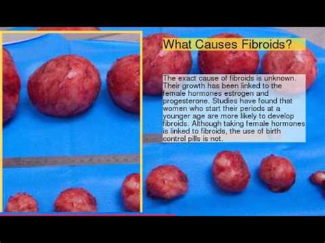 Uterine Fibroid Size Chart In Mm