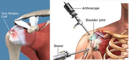 What Is Rotator Cuff Surgery Recovery Time? | New Health Advisor