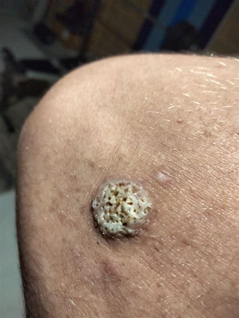 Not a wart but looks like one, near my elbow : r/Warts