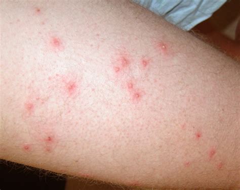 Pseudomonas Folliculitis : A Bacterial Folliculitis That Can Not Be Avoid | HubPages