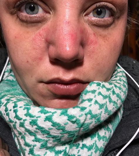 Is this Rosacea?? Dry, cystic type bumps, red, coarse, and sorrow. : r/Rosacea