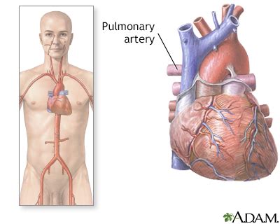 Pulmonary angiography Information | Mount Sinai - New York