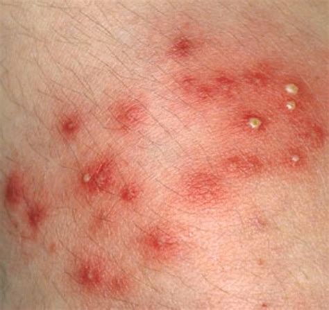 Staph Infection: Causes, Contagious, Symptoms, Treatment, and Pictures - YouMeMindBody