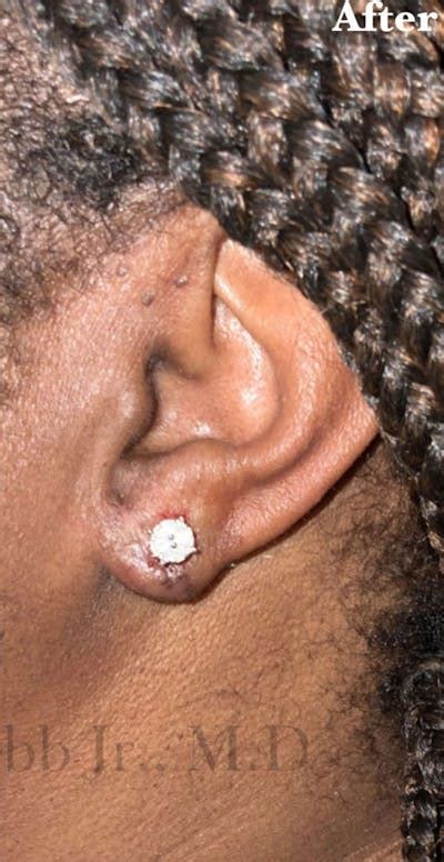 Ear Lobe Repair Before & After Photos | Robb Facial Plastic Surgery