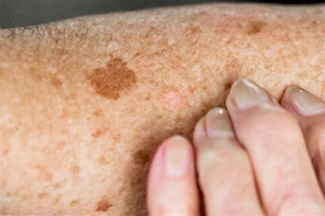 Can Age Spots Be Raised? Exploring The Truth Behind Skin Bumps