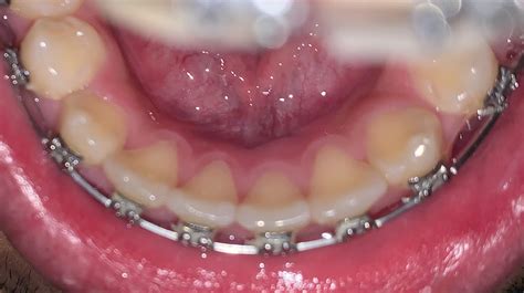 Are my gums behind bottom teeth receding? : r/PeriodontalDisease