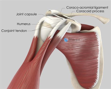 Coracoid Block (Latarjet Procedure) - Doctor Matthieu Meyer