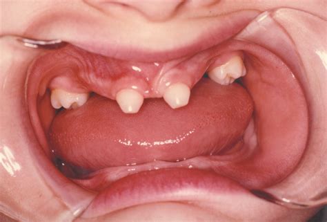 Dental Symptoms - Ectodermal Dysplasia | NFED