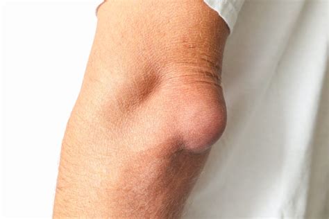 What is Olecranon Bursitis & How to Manage Elbow Pain? - Upswing Health