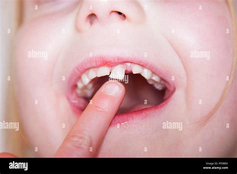 Milk teeth fall out hi-res stock photography and images - Alamy